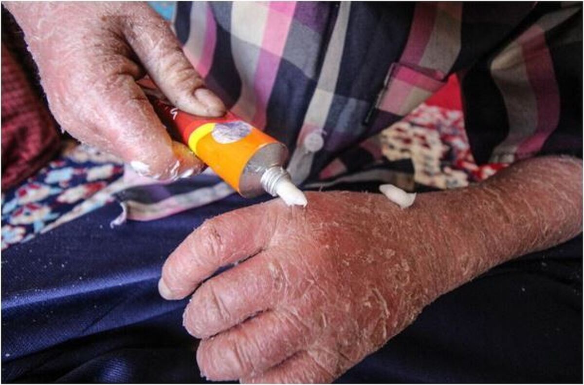 سرنوشت نوزاد پروانه‌ای رها شده در بیمارستان