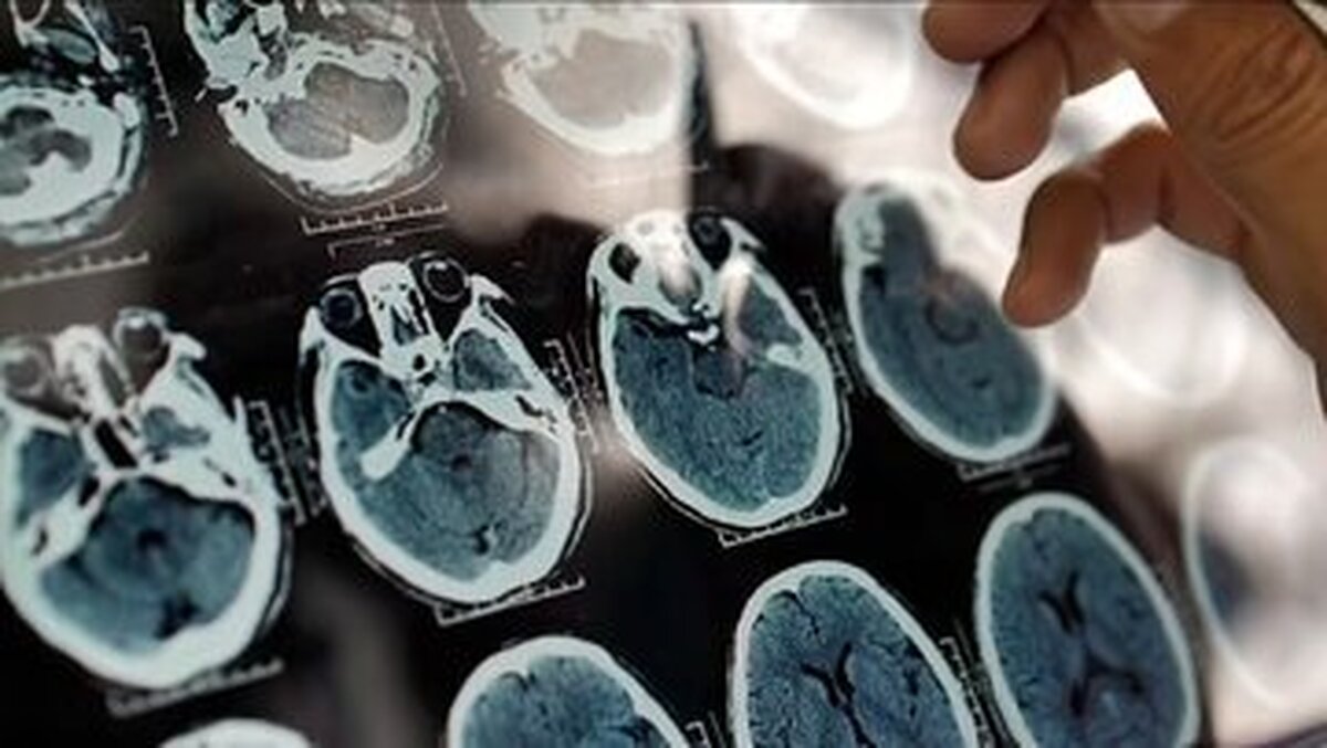 نشانه‌های پیری زودرس مغز را جدی بگیرید