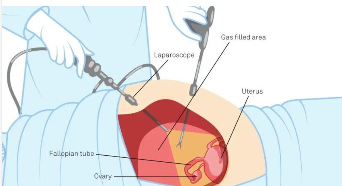 جراحی با روش لاپاراسکوپی یا لاپاراتومی/کدام بهتر است؟