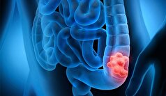 جلوگیری از سرطان روده اینگونه ممکن میشود!