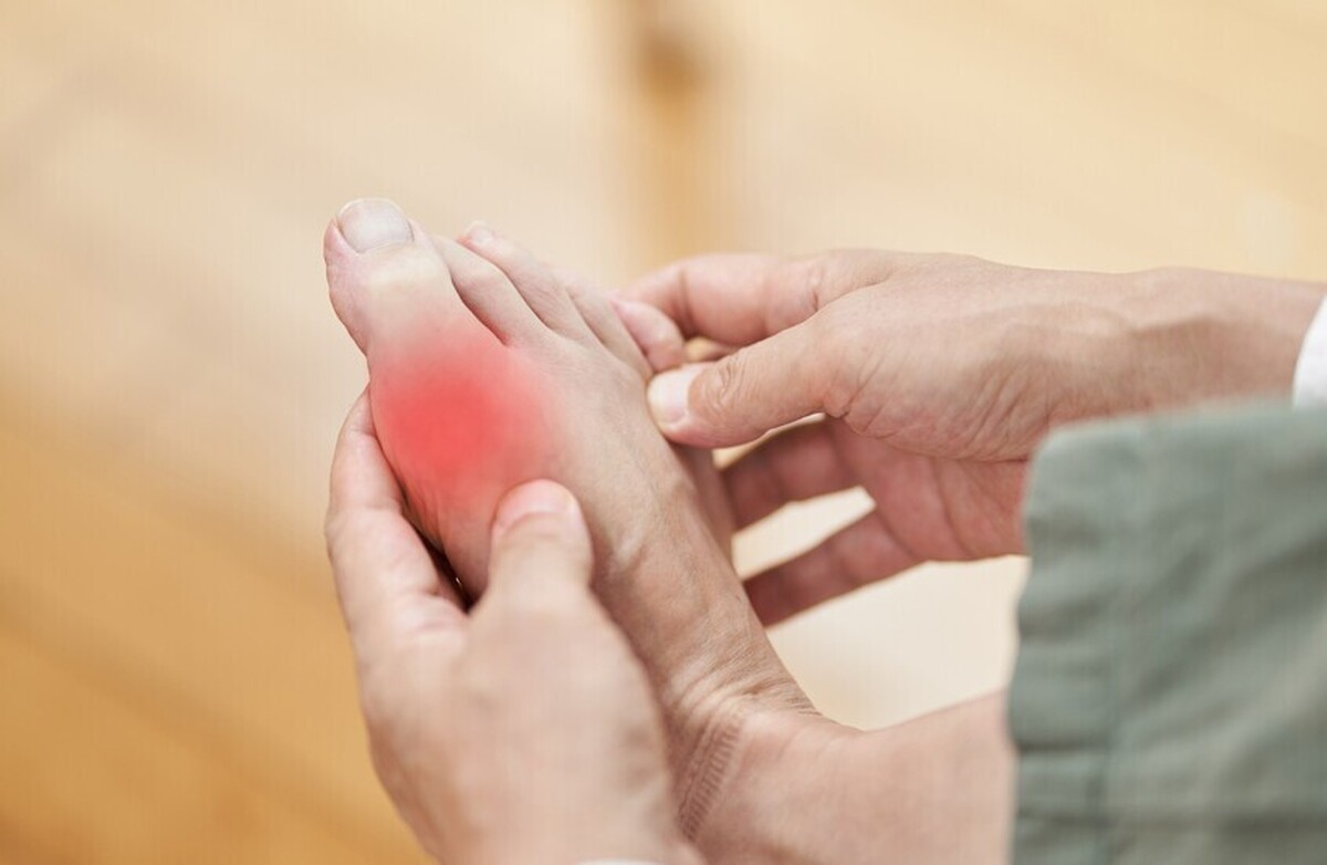 حقیقت نقرس کشف شد