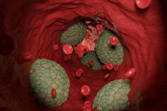 نشانه‌هایی از خطر بالای ژنتیکی ابتلا به تصلب شرایین شناسایی شده است