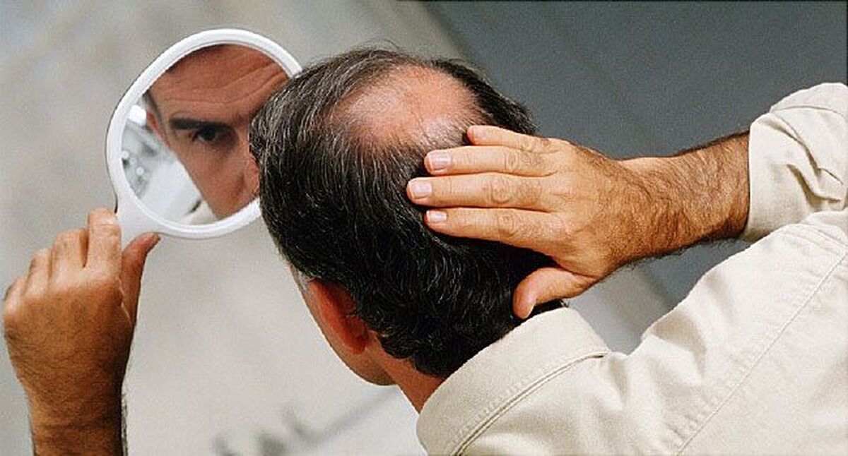 باید و نباید‌ها درباره کاشت مو که باید قبل از انجام دادن آن بدانید