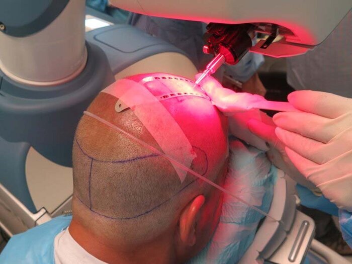 اطلاعات و تفکرات نادرست درباره کاشت مو که باید دور بریزید!