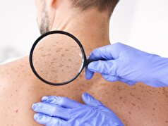 تابستان‌های گرم‌تر ممکن است در افزایش موارد سرطان پوست نقش داشته باشند