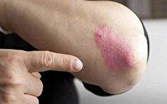 چگونه می‌شود پسوریازیس را کنترل کرد؟