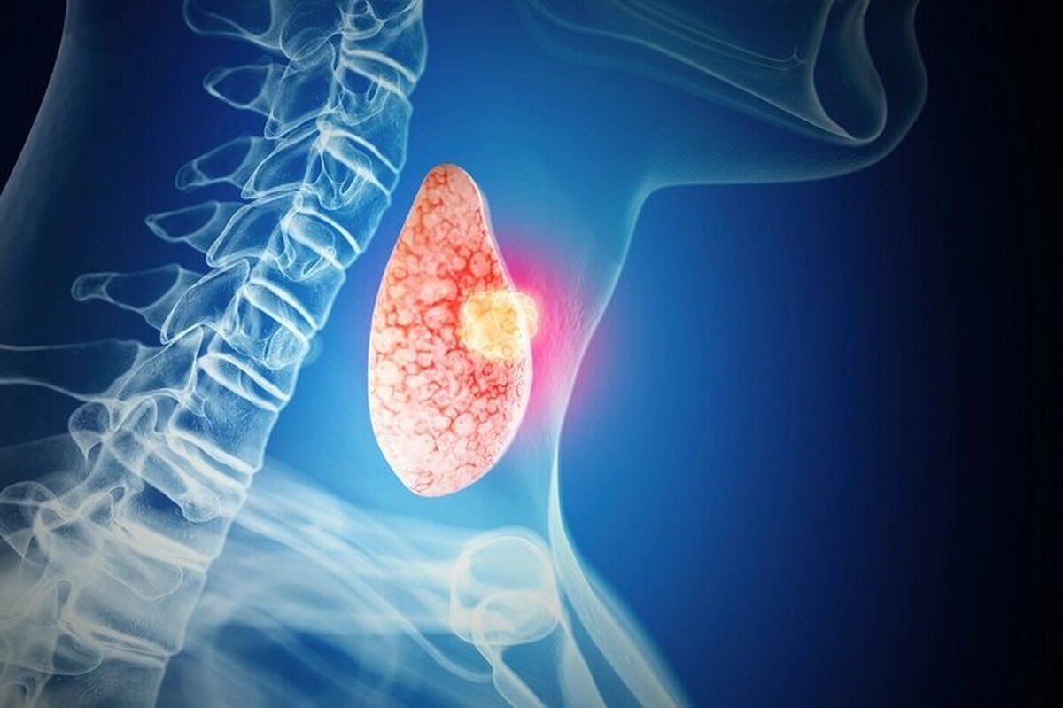 آشنایی با انواع سرطان‌های تیروئید و علت ابتلا به آن