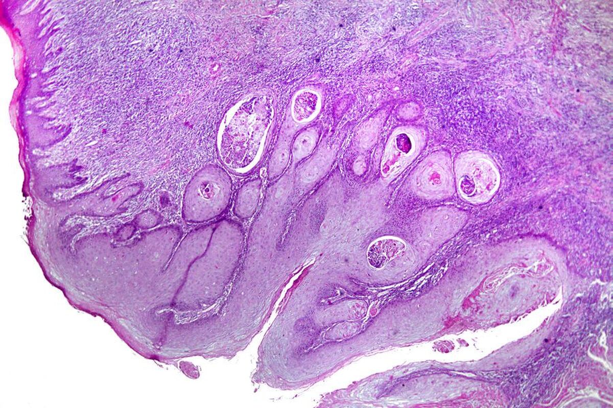 ویروسی کشف شده است که به مبارزه با سرطان پوست کمک می‌کند.