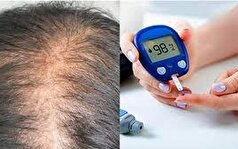 افراد مبتلا به دیابت ریزش مو دارند؟