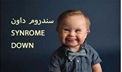 تشخیص زودهنگام سندروم داون از روی استخوان بینی جنین