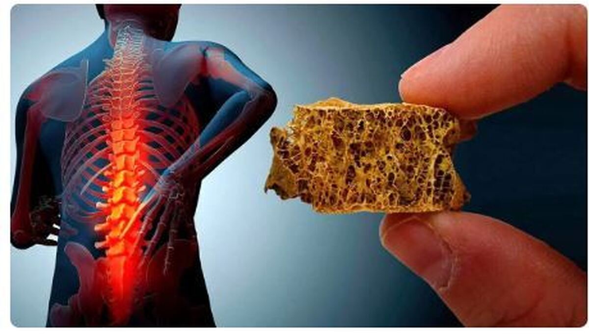 معکوس سازی روند پوکی استخوان ممکن شد