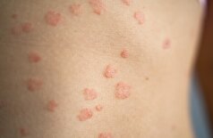 «سوپر قارچ‌ها» اروپا را تهدید می‌کنند... مقاومت دارویی و شیوع سریع!