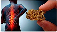 معکوس سازی روند پوکی استخوان ممکن شد