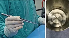 جراحان برای اولین بار یک کرم گرد زنده را از مغز یک زن خارج کردند.