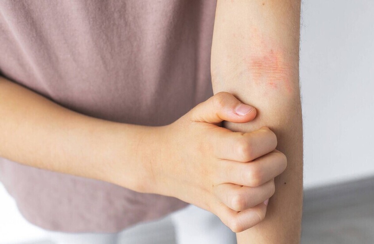 بیماری‌های پوستی که در پاییز و زمستان تشدید می‌شوند