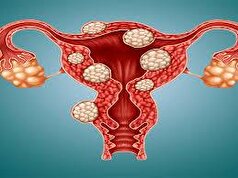 فیبروم‌های رحمی با چه اندازه‌ای نیاز به عمل دارند؟