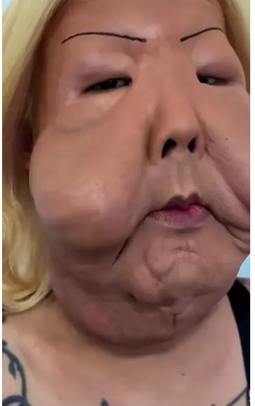 اینفلوئنسر برزیلی بعد از زندگی با یک چهره عجیب بدلیل عمل زیبایی ناموفق خودش را بازسازی کرد!