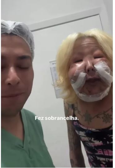 اینفلوئنسر برزیلی بعد از زندگی با یک چهره عجیب بدلیل عمل زیبایی ناموفق خودش را بازسازی کرد!