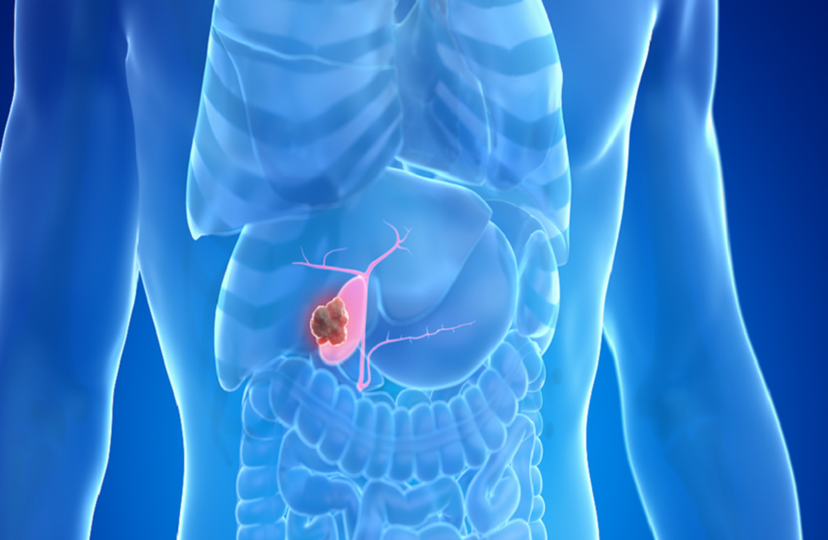 یک تغییر ساده در رژیم غذایی ممکن است خطر ابتلا به سرطان خاموش را کاهش دهد!