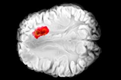 داروی کنترل فشار خون میتواند یکی از کشنده‌ترین سرطان‌های مغز را درمان کند!
