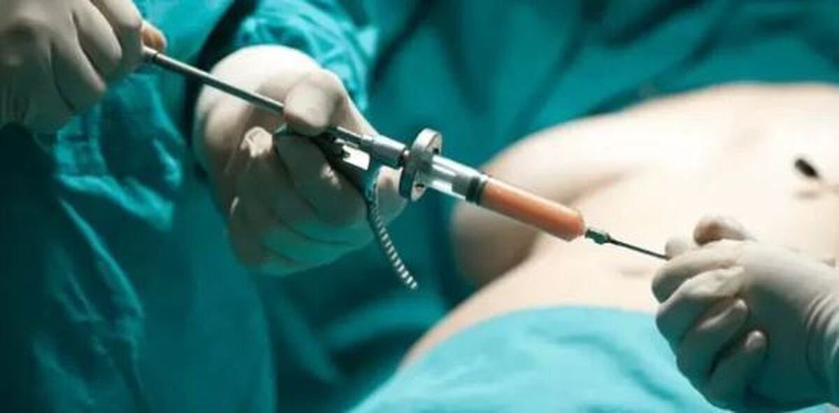 اکثر افرادی که عمل جراحی لیفت باسن برزیلی را انجام داده‌اند ا آن پشیمان هستند!