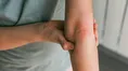 پزشکان در مورد تأثیر پسوریازیس بر خطر حملات قلبی و سکته مغزی بحث کردند