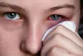 ارتباط میان قرمزی چشم و کرونا: ورم ملتحمه چیست؟