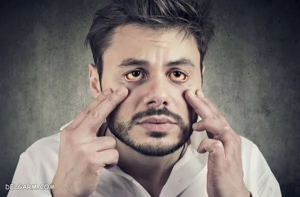 از رنگ‌پریدگی تا مه‌آلودگی ذهنی؛ نشانه‌های پنهان کمبود آهن چیست؟