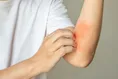 خطر اصلی پسوریازیس شناسایی شد