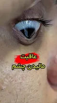 فیلم| عاقبت مالیدن چشم