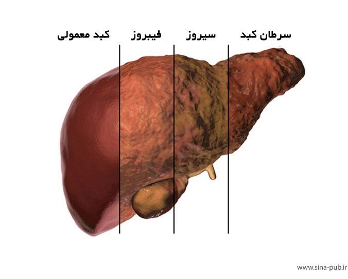 سکته عامل مرگ ۸۰ درصد مبتلایان کبد چرب پیشرفته 