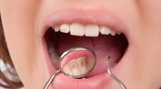 تاثیر عصاره رزماری و میخک بر باکتری‌های عامل پوسیدگی دندان