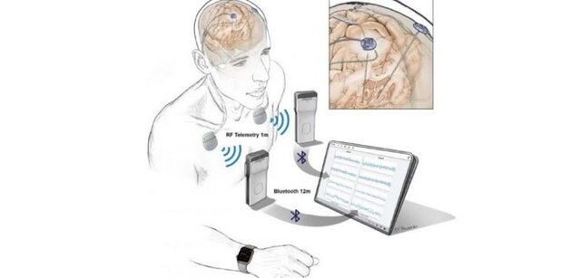 توسعه دستگاههای ردیابی فعالیت مغز به منظور درمان بیماری‌های مغزی