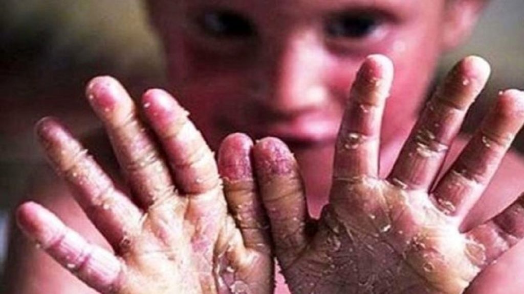 وحشتناک‌ترین بیماری پوستی جهان را بشناسید